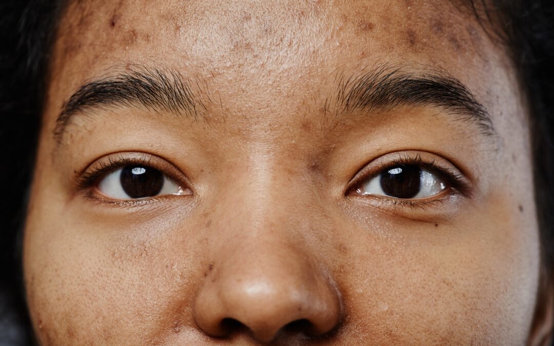 Combating Hyperpigmentation: Top Aesthetic Treatments for a Brighter, More Even Complexion