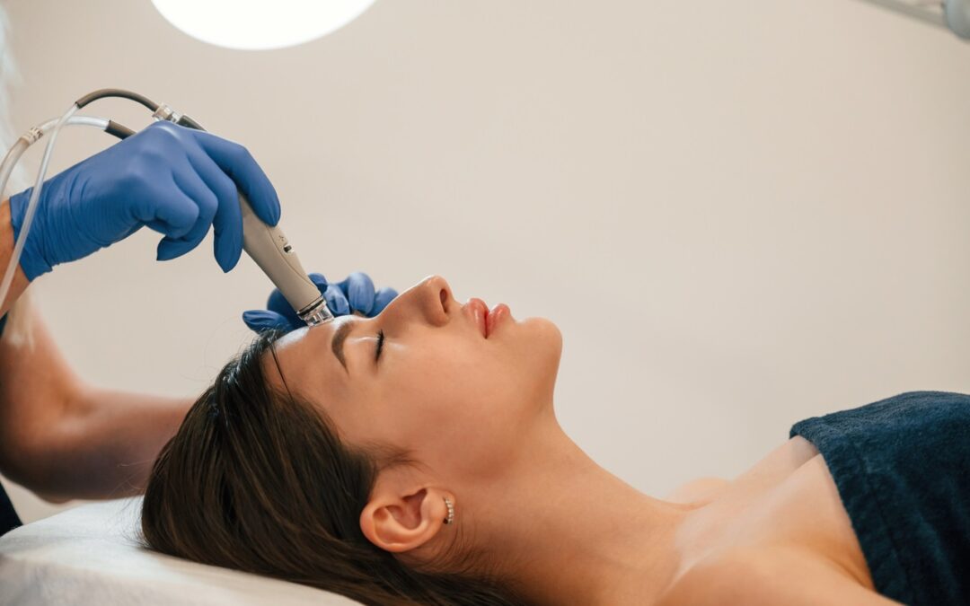 How Microneedling Helps Treat Acne Scars